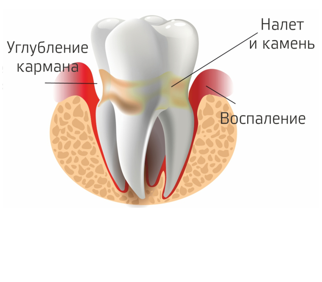 периодонтит - изображение 3
