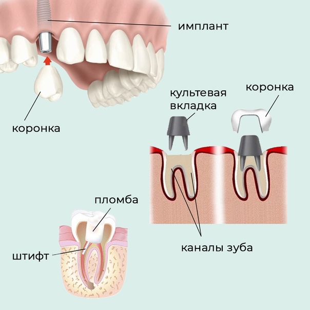 штифт и коронка фото