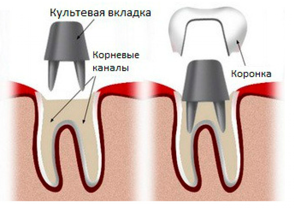 как ставят коронку на зуб фото
