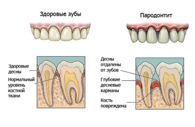 пародонтит - изображение 6