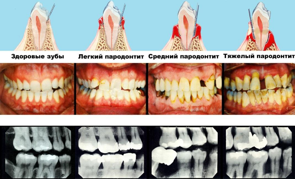 пародонтит - изображение 2