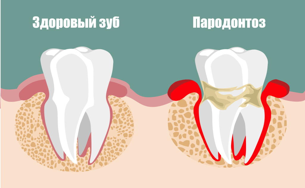 пародонтоз - изображение 1