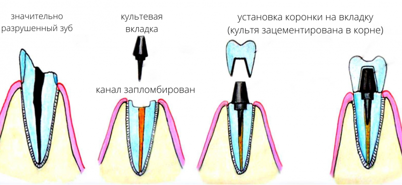 установка культевой вкладки фото