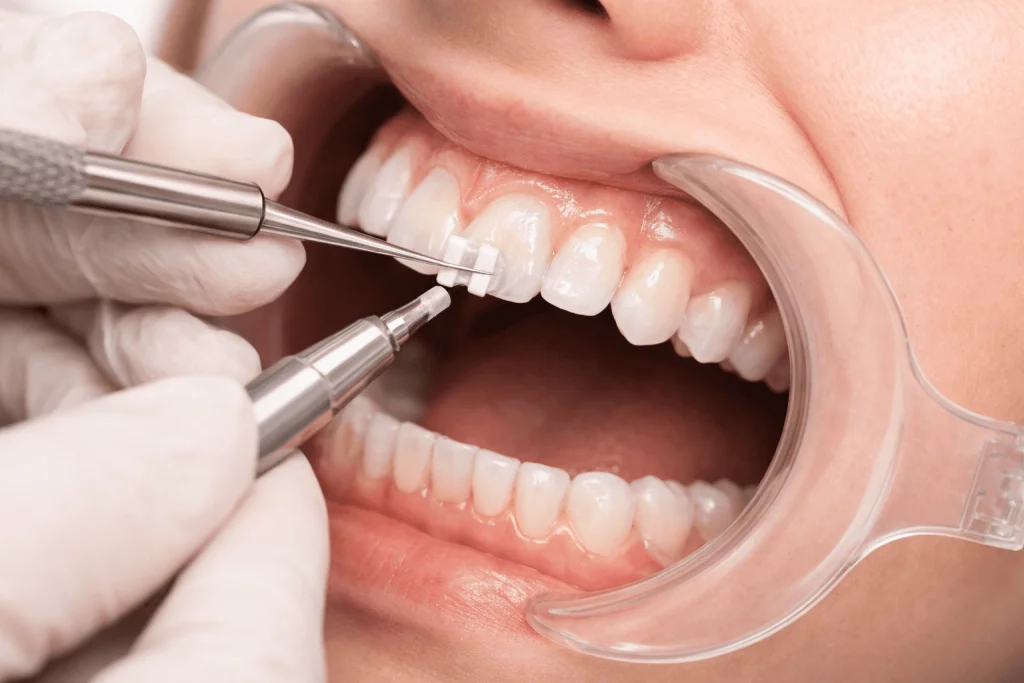 плюсы и минусы сапфировых и керамических брекетов