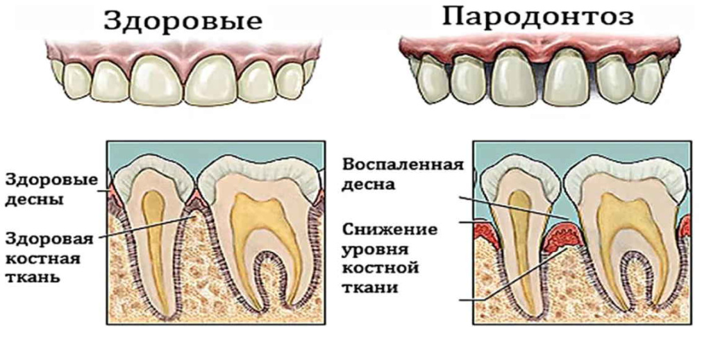 пародонтоз - изображение 4