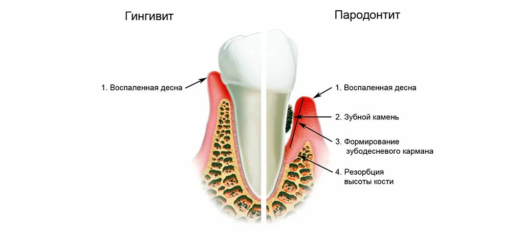 гингивит десен фото