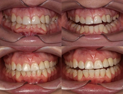 Устранили скученность и тесное положение зубов на элайнерах Sparks