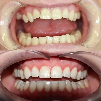 Исправили неправильный прикус на элайнерах Star Smile за 25 месяцев