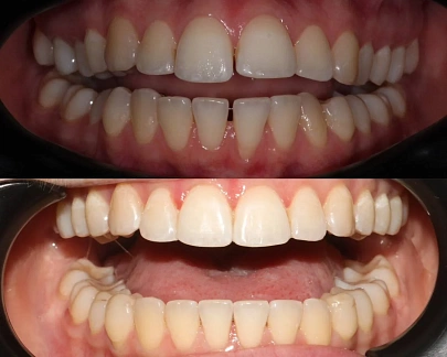 70 кап без единого дозаказа — сложный случай на элайнерах Spark за 3,5 года