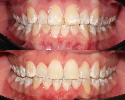 Лечение неправильного прикуса на элайнерах Click Aligners