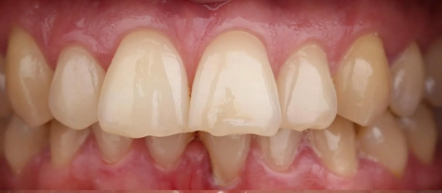 Сужение челюстей, выступающие резцы и скученность — 81 капа на элайнерах Spark