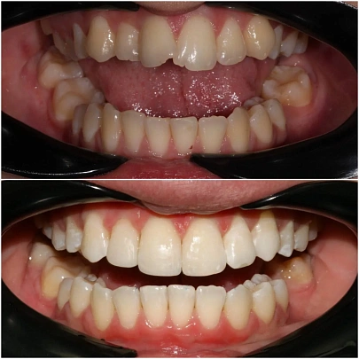 Лечение на элайнерах 3D Smile — выровняли зубы и исправили смыкание