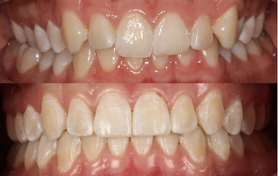 Лечение прикуса на элайнерах Invisalign — от неправильного прикуса к ровной улыбке