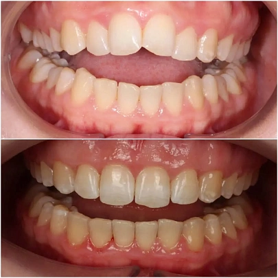 Лечим прикус на металлических брекетах H4 при сужении обеих челюстей за 25 месяцев