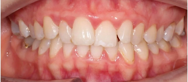 Комплексный подход в лечении прикуса на элайнерах 3D Smile