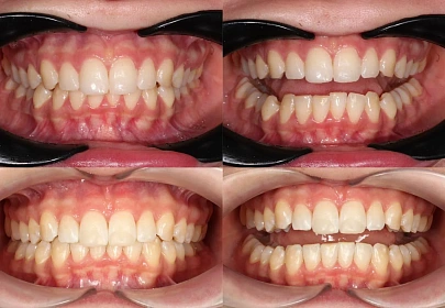 Скученность зубов — выравнивание зубов на элайнерах Click Aligners