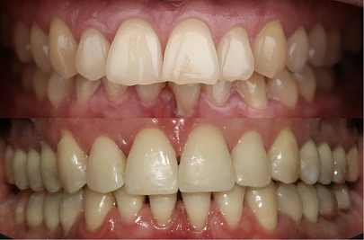 Сужение челюстей, выступающие резцы и скученность — 81 капа на элайнерах Spark