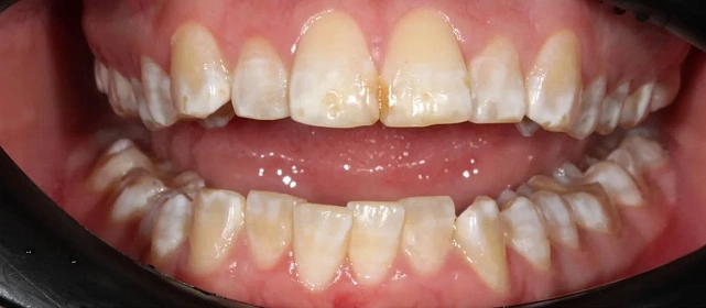 Лечение неправильного прикуса на элайнерах Click Aligners