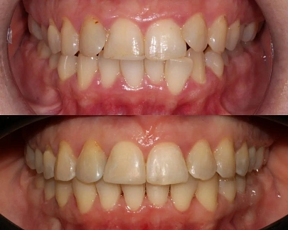 Лечение скученности и неправильного прикуса на элайнерах 3D Smile