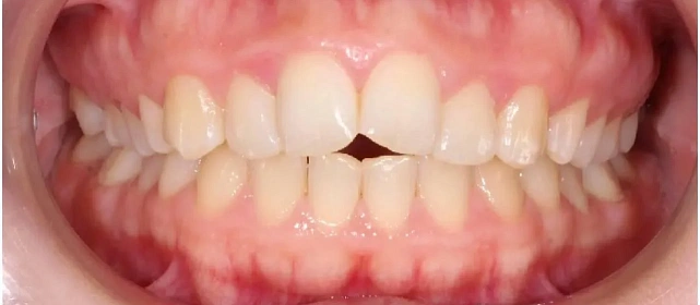 Лечим прикус на металлических брекетах H4 при сужении обеих челюстей за 25 месяцев