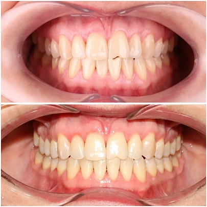 Скученность, сужение челюстей и открытый прикус — лечение на элайнерах Click за 9 месяцев