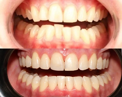 Неправильный прикус — лечение на элайнерах Spark