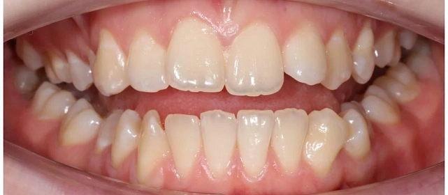 Неровные зубы и нарушение прикуса — лечение на элайнерах 3D Smile