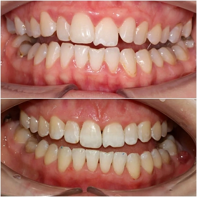 Комплексный подход в лечении прикуса на элайнерах 3D Smile