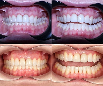 Скученность, глубокий прикус и старые коронки — лечение на элайнерах Click Aligners