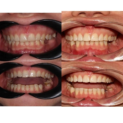 Исправление прикуса на брекетах за 28 месяцев перед протезированием