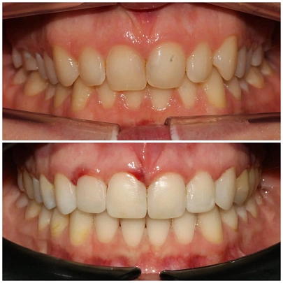 Выровняли и подготовили к реставрации зубы на керамических брекетах Damon за 14 месяцев