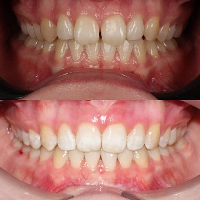 Скученность и сужение челюстей вылечили на брекетах всего за 15 месяцев