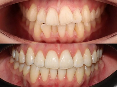 Неправильный прикус и положение зубов — лечение на элайнерах Spark