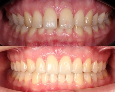 Неправильный прикус и положение зубов — лечение на элайнерах 3D Smile