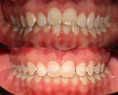 Лечение неправильного положения зубов на брекет-системе за 14 месяцев